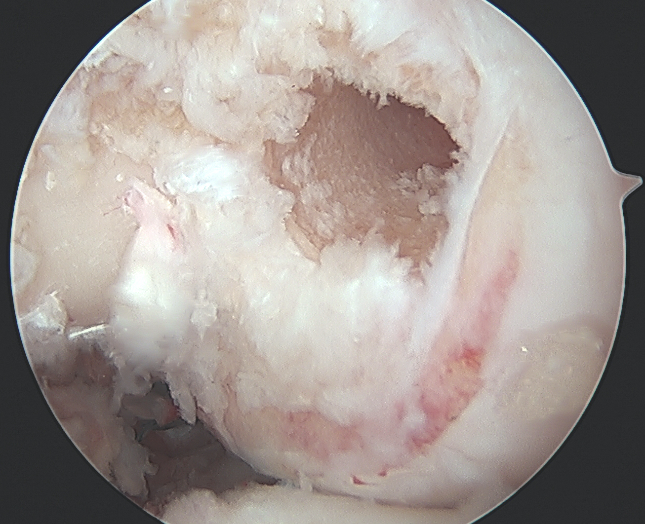 PCL femoral tunnel 3